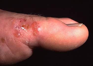 Que ungüento puede ayudará de la psoriasis